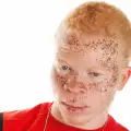Албинизъм