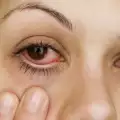 Кръвоизливи в очите