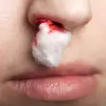 Причини за кървене от носа