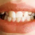 Скърцане със зъби - бруксизъм