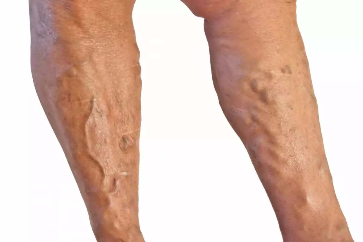 Венозна Склероза на Вените на Краката