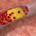 Наночастици погват артериалните плаки