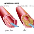 Атеросклероза
