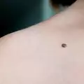 Как да се отървете от бенка с домашни средства