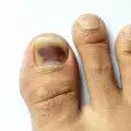 Пет причини за почерняване на ноктите на краката