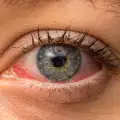 Заболявания на ретината