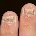 Как да се справим с гъбички по ноктите