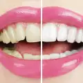 Как да се справим с петната по зъбите?
