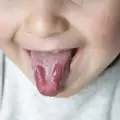 Болест на Кавазаки
