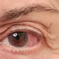 Възпаления на очите
