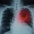 Симптоми за рак на белия дроб