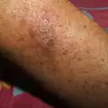 Пемфигус