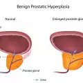 Причини за рак на простатата