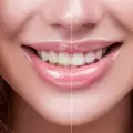 Как да избелим зъбите си