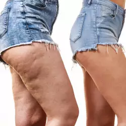 Може ли да се третира целулитисът в домашни условия?