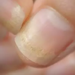 Псориазис по ноктите