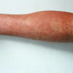 Червен обрив по кожата – симптом за непоносимост към глутен