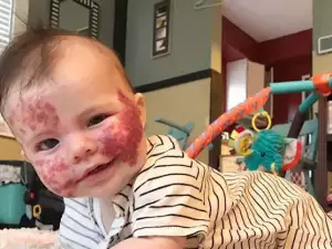 Недъгът на това бебе до превърна в модел! Вижте го