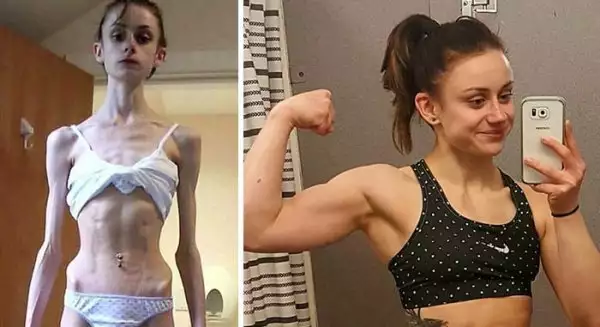 Преди и сега: Снимки на жени, които пребориха анорексията