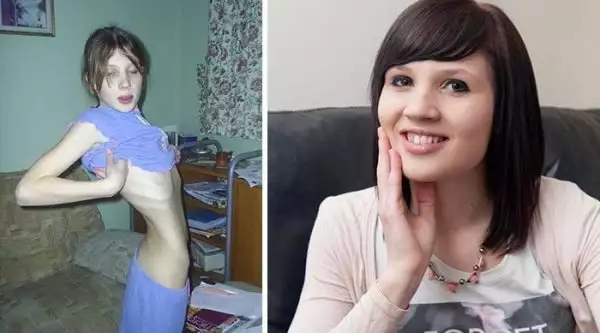 Преди и сега: Снимки на жени, които пребориха анорексията