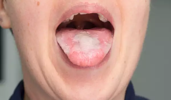 Белите петна по езика могат да са признак за гъбично заболяване.