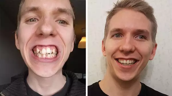 Преди и след: Невероятната трансформация на хора, носили брекети