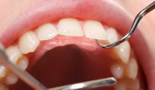 Вадене на зъби