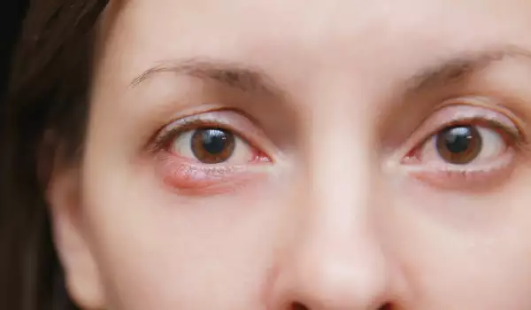 Вътрешен ечемик на окото - какво трябва да знаем