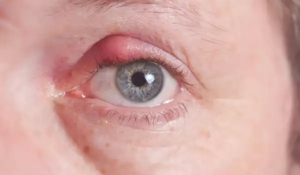 Как се прави компрес при ечемик на окото?