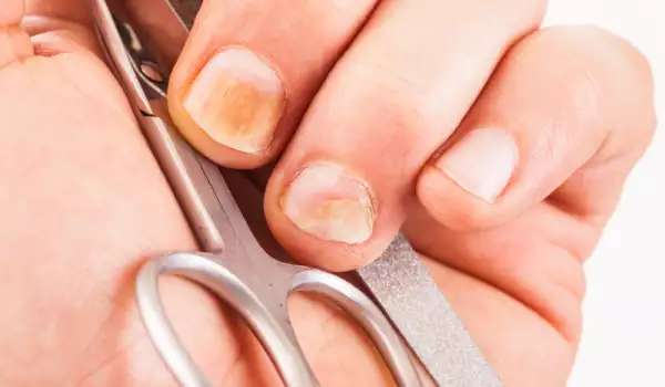 За връзката между гел лака и гъбичките по ноктите