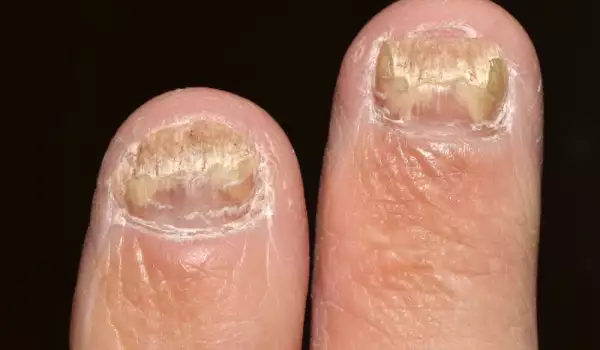 Как да се справим с гъбички по ноктите