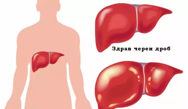 Възпаление на черния дроб при Хепатит Б