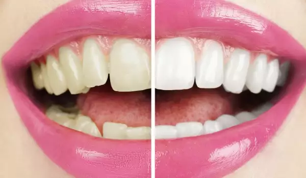 Бели зъби