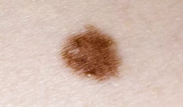 Рак на кожата