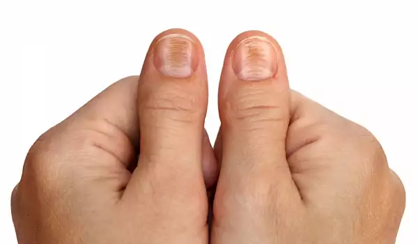 Как да се отървете от досадните неравности по ноктите