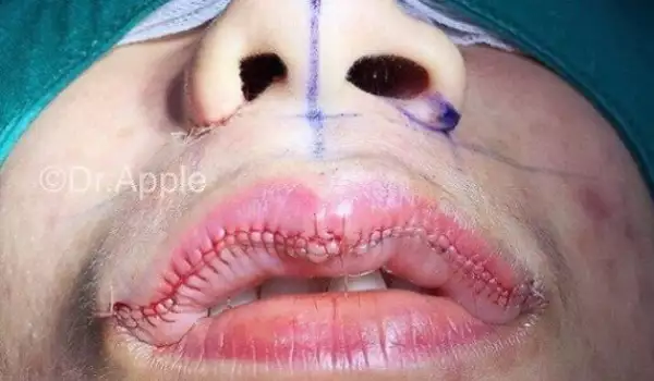 Нова мода: Хирурзи зашиват устните ви за по-скромна усмивка