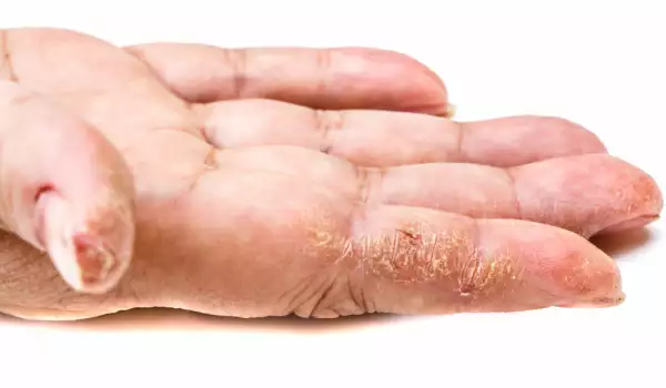 Есенна грижа за ръцете при студов дерматит