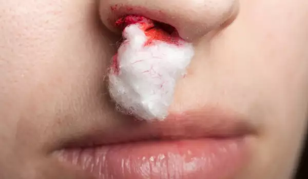 Кървене от носа