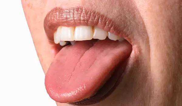 Премахване на налепи по езика