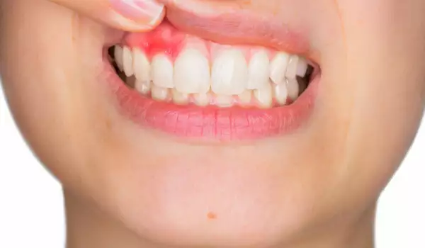 Как да заздравим венците си
