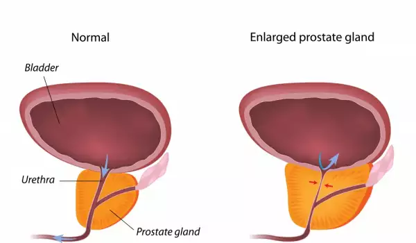 Причини за рак на простатата