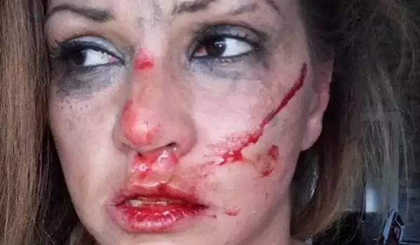 Кървав ужас! Българска певица е била пребита от приятеля си швед