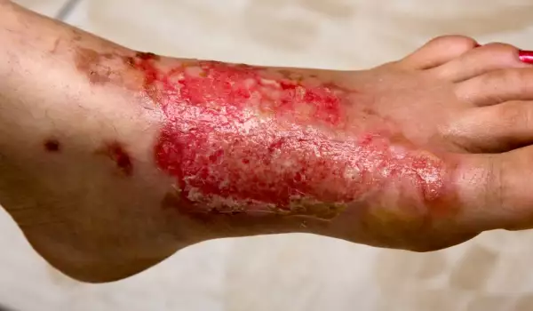 Защо се образуват мехури по кожата?
