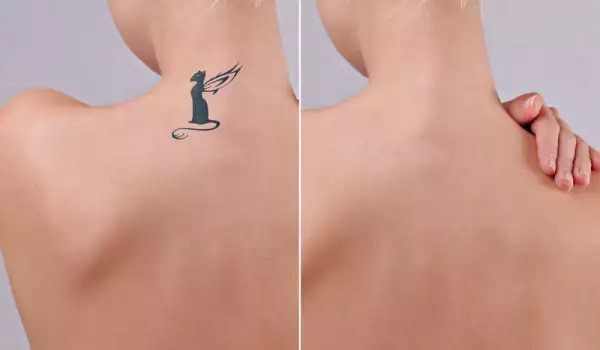 Преди и след премахване на татуировка
