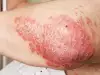 Лечение на псориазис с уринотерапия