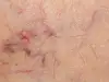 Защо се пукат капилярите?